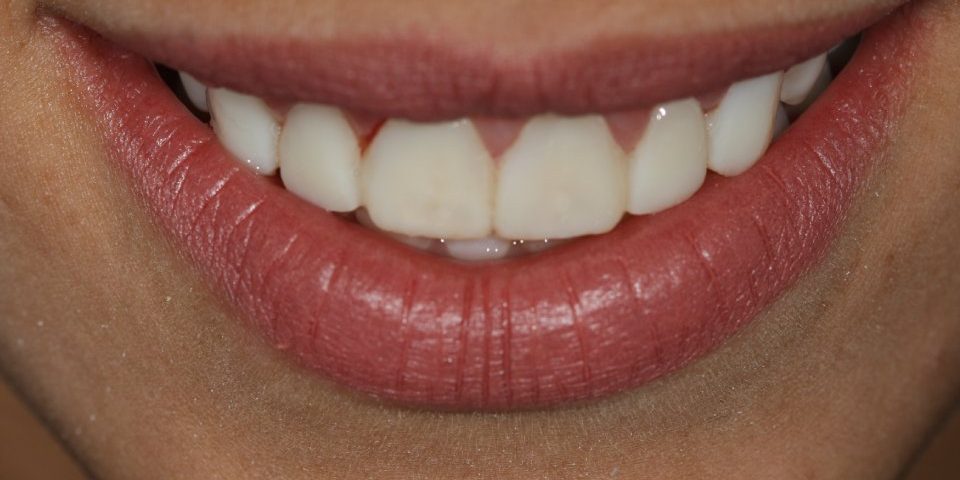 Lentes de contato dental, que é esse tratamento?