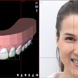 Lente de porcelana e DSD Digital Smile Design