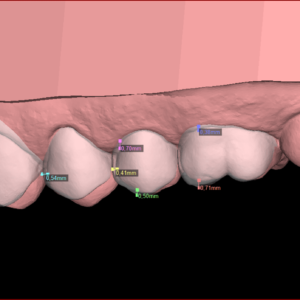 Lente de porcelana e DSD Digital Smile Design