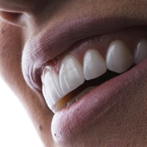 Lente de porcelana e DSD