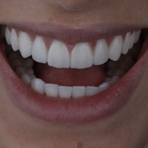 Mais do que estética, seu sorriso confiante com lente de porcelana