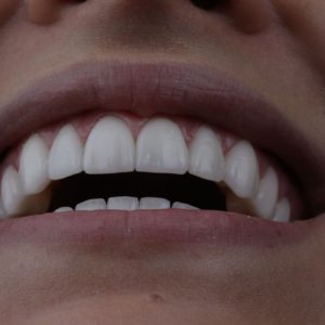 Mais do que estética, seu sorriso confiante com lente de porcelana