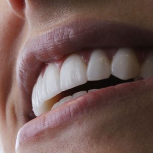 Mais do que estética, seu sorriso confiante com lente de porcelana