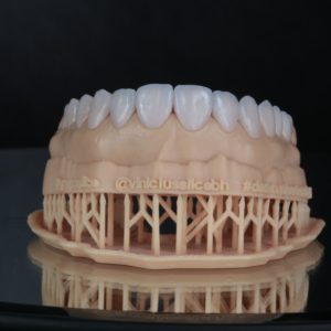 Lente de porcelana sorriso hi-tech DSD