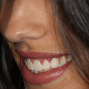 Lentes de contato dental, que é esse tratamento?