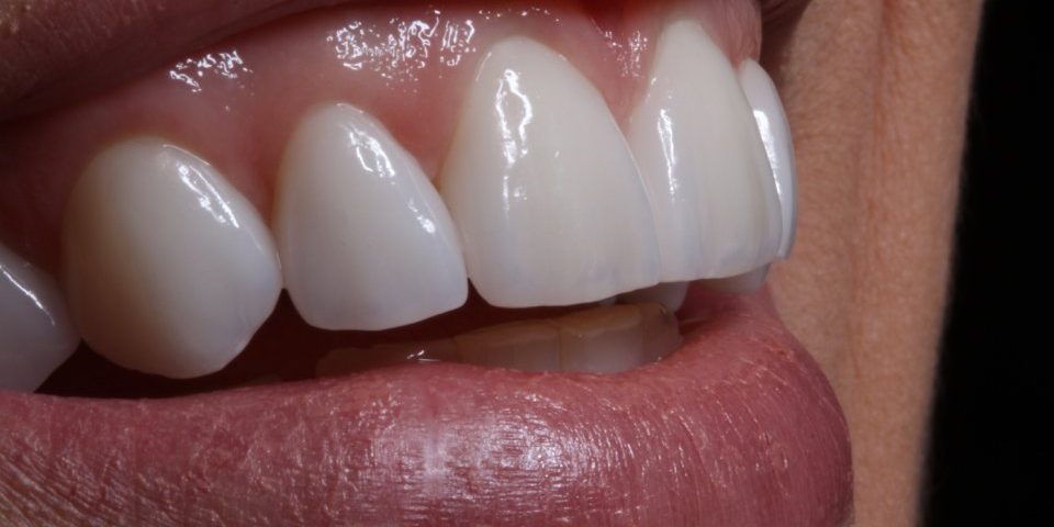 Lente de porcelana e DSD Digital Smile Design