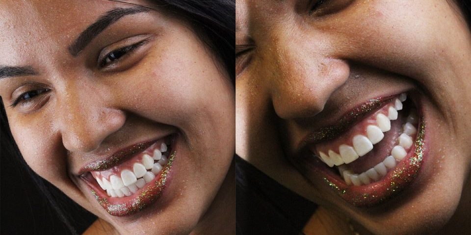 Sorrisos em cada detalhe, com lente de porcelana