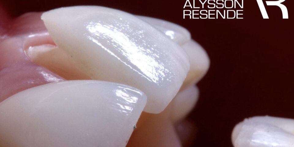 Sorriso perfeito no dia do casamento com lentes de porcelana