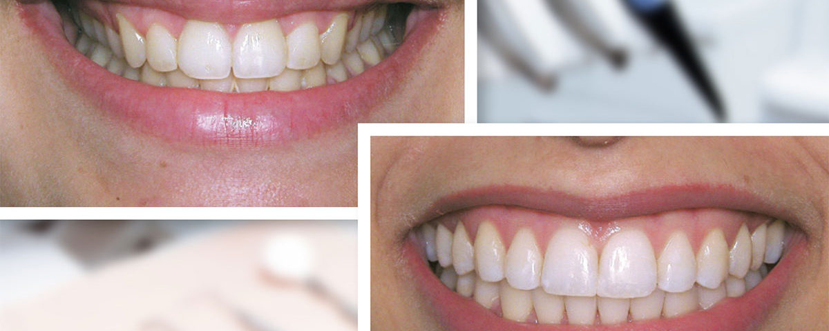 Alongamento do sorriso