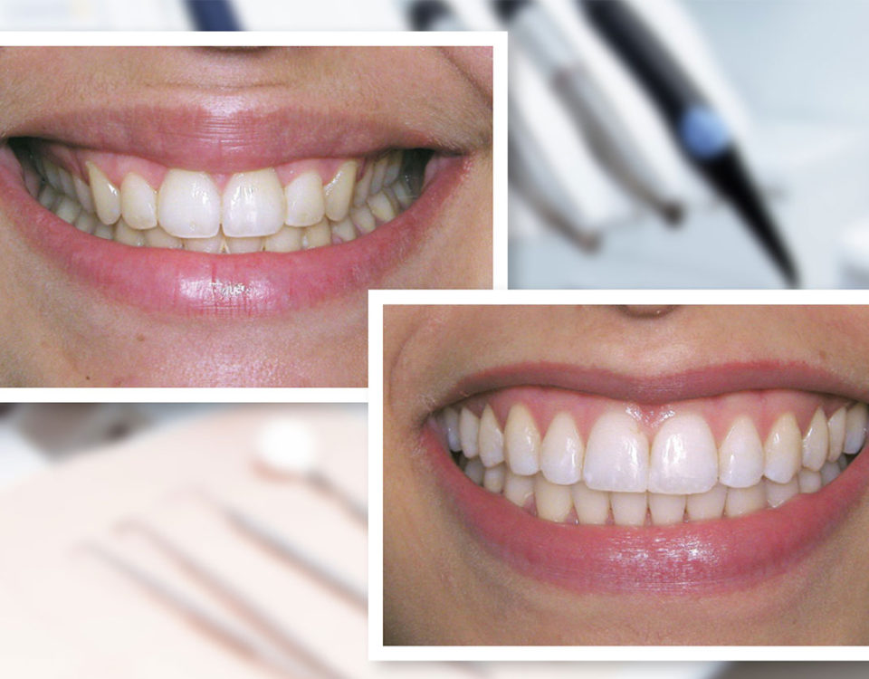 Alongamento do sorriso